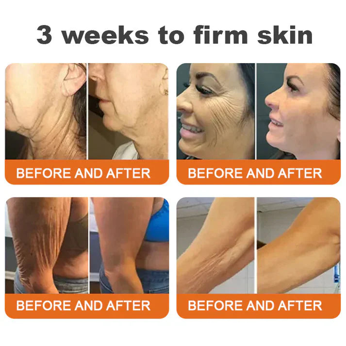 Flysmus Botox