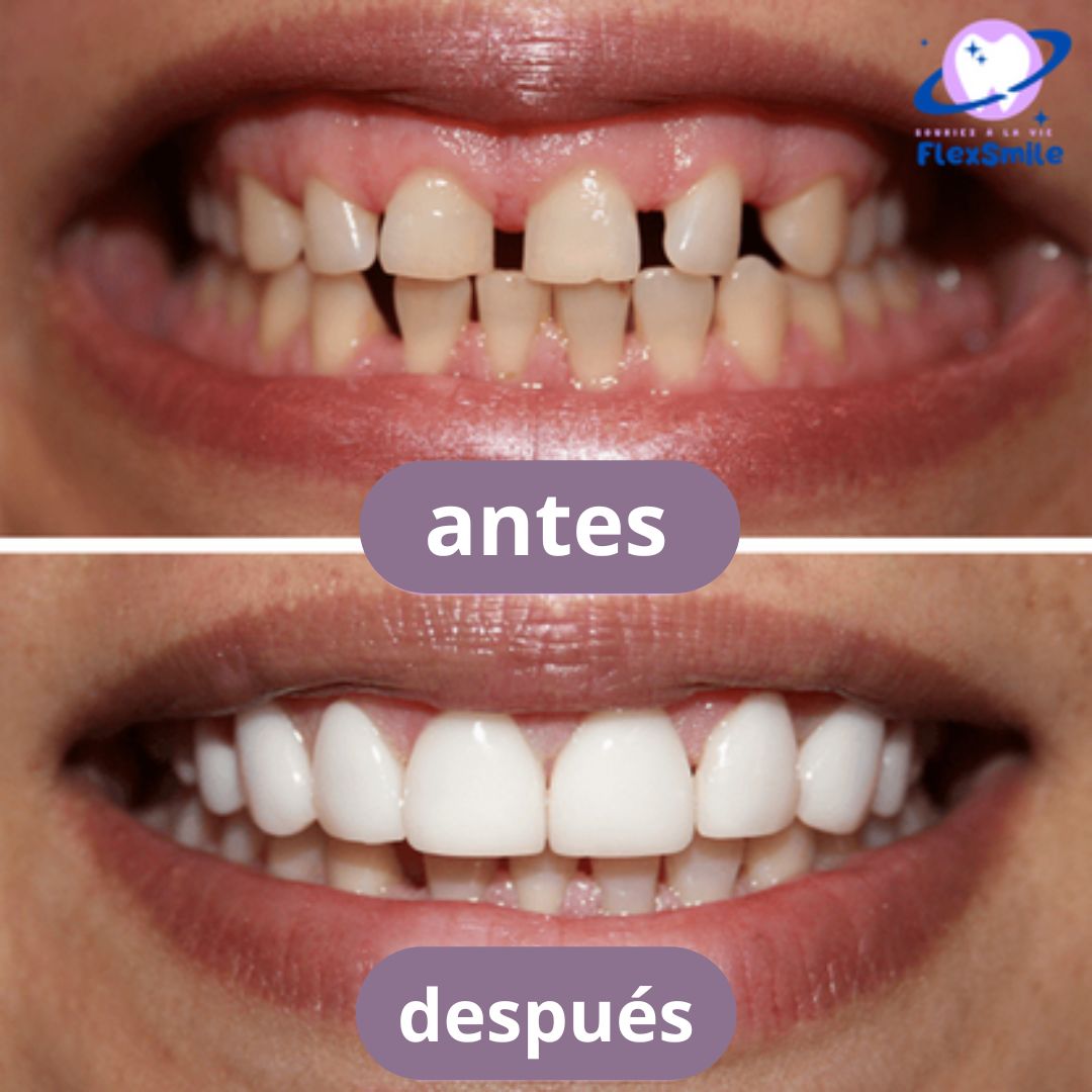 KitSmile® - Carillas Dentales (Kit Completo)