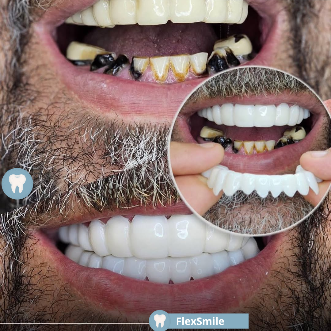 FlexSmile® - Carillas Dentales