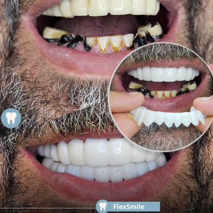 FlexSmile® - Carillas Dentales