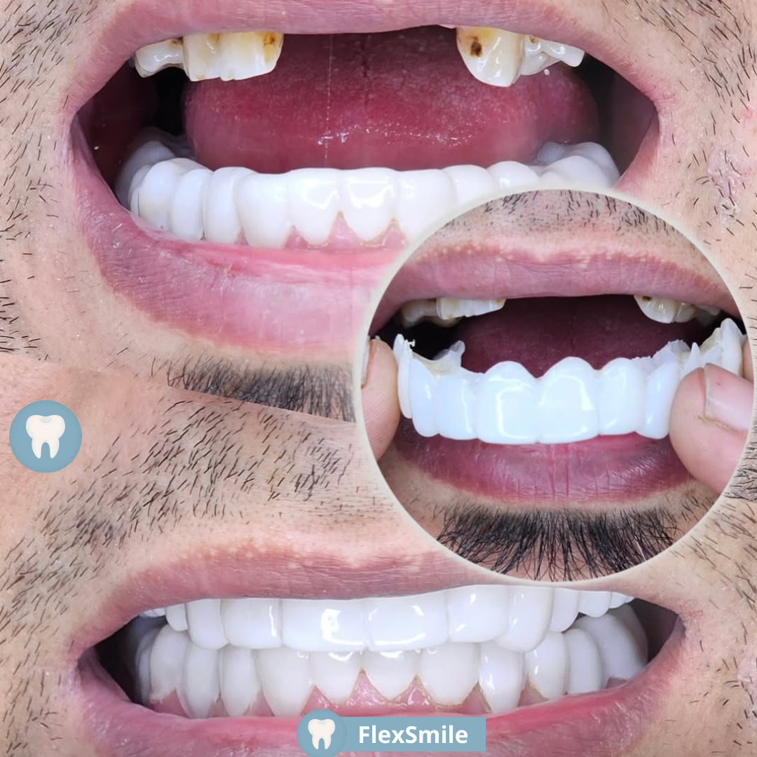 FlexSmile® - Carillas Dentales